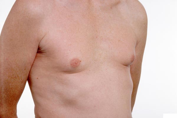 Dấu hiệu bệnh ung thư vú ở nam giới